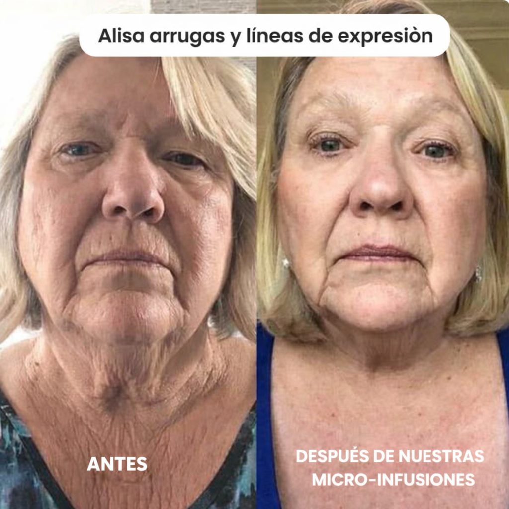 Micro Infusión Anti Edad