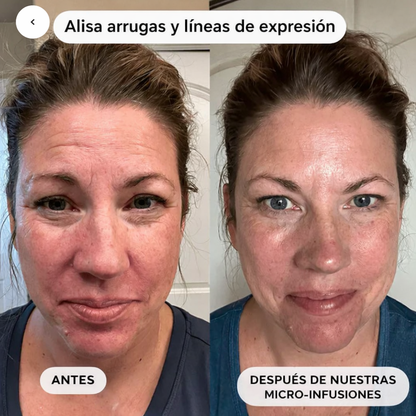 Micro Infusión Anti Edad